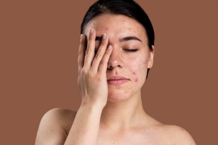 Косметолог Василенко назвала главные ошибки при лечении акне